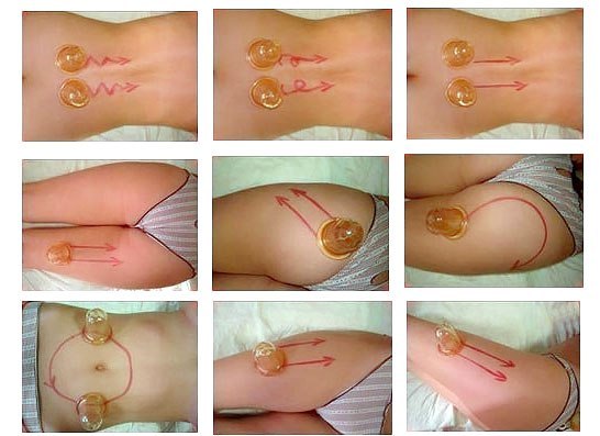 Баночный массаж Баночный массаж