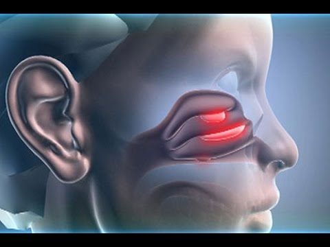 Как лечить полипы и кисты. Алёна Полынь