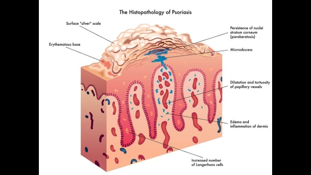 Причины псориаза. Алексей Трёхлебов
