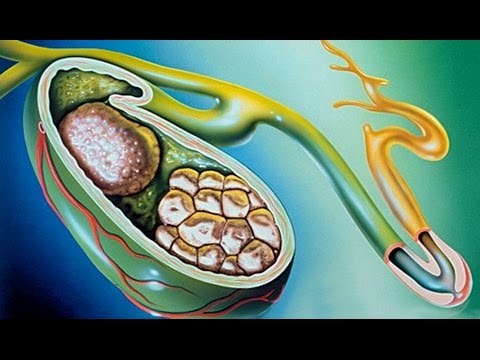 Можно ли удалять жёлчный пузырь при камнях в нём? Алена Полынь