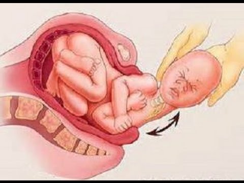 Травма при рождении у каждого ребенка. Александр Штукатуров