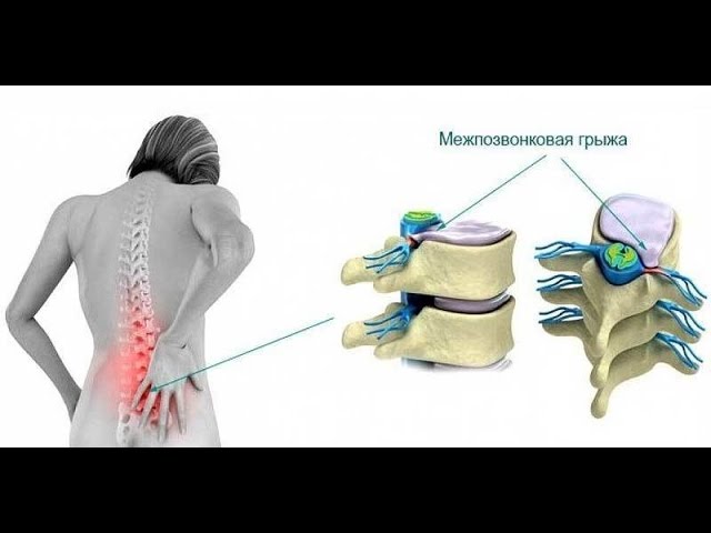 Как не допустить позвоночных грыж